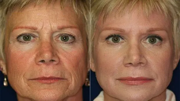 Alexandra Before and After